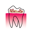 Dentihex - Gingivitis