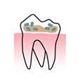 Dentihex - Tartar